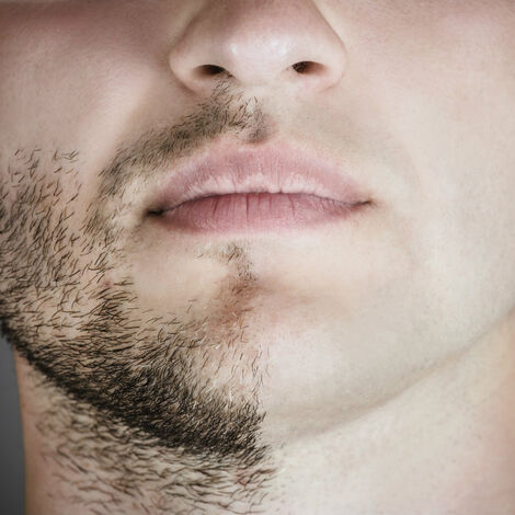 Poils-incarnes-barbe-1