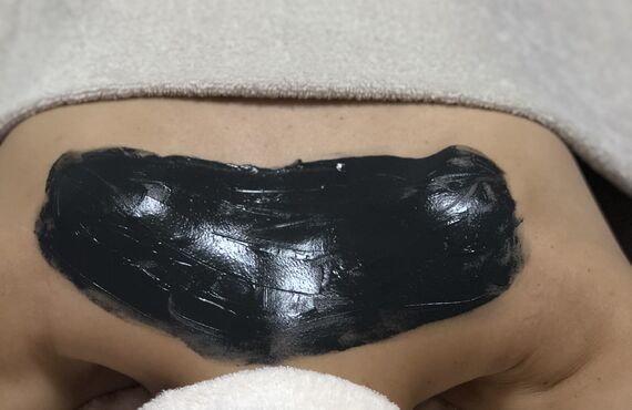 背中ニキビにブラックピーリングがオススメ